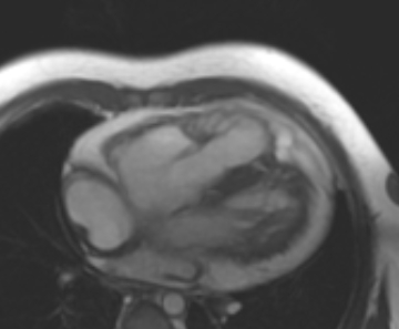 File:Arrhythmogenic right ventricular cardiomyopathy (Radiopaedia 69431-79307 4ch cine 62).jpg
