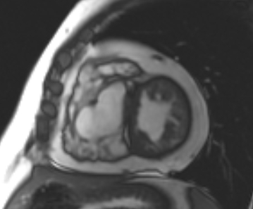 File:Arrhythmogenic right ventricular cardiomyopathy (Radiopaedia 69431-79307 Short axis cine 113).jpg
