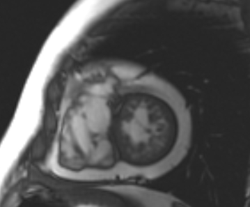 Arrhythmogenic right ventricular cardiomyopathy (Radiopaedia 69431-79307 Short axis cine 72).jpg