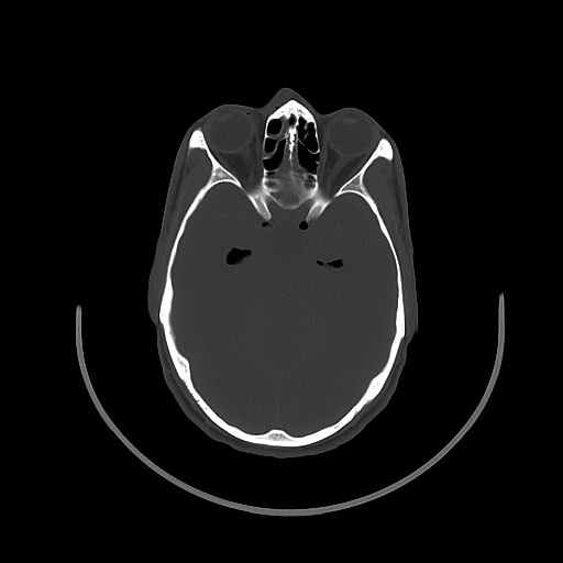 Arrow injury to the brain (Radiopaedia 72101-82607 Axial bone window 65).jpg
