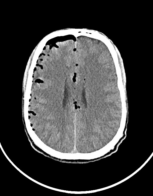 Arrow injury to the brain (Radiopaedia 72101-82607 Axial non-contrast 78).jpg