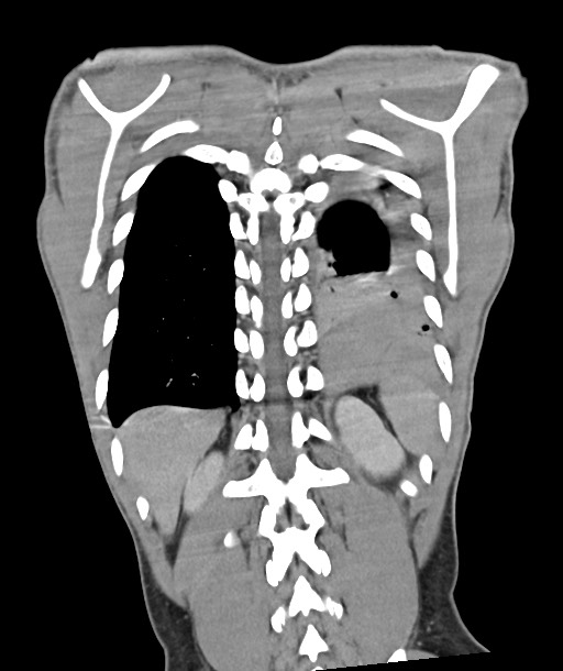 Arrow injury to the chest (Radiopaedia 85367-100975 F 105).jpg