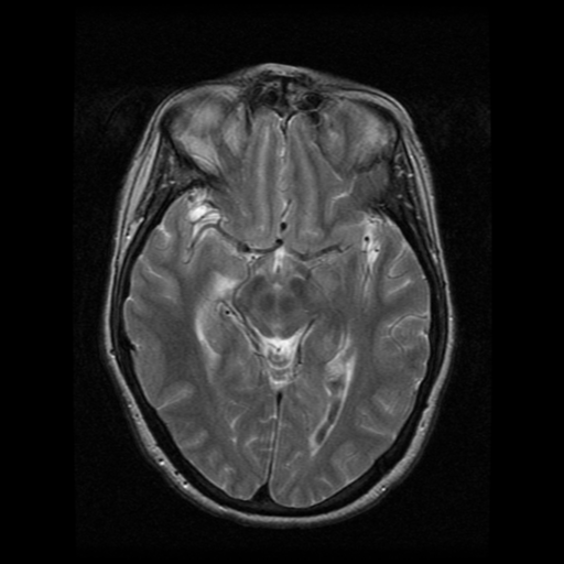 File:Arteriovenous malformation (cerebral) (Radiopaedia 40070-42580 Axial T2 11).png