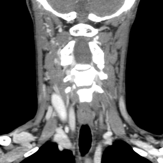 File:Arteriovenous malformation of the neck (Radiopaedia 53935-60062 D 8).jpg