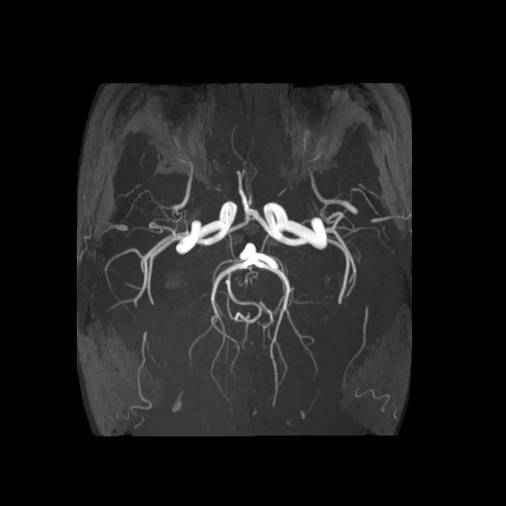 Artery of Percheron infarct (Radiopaedia 40966-43676 F 37).jpg