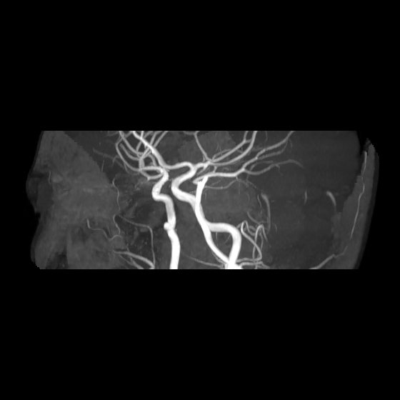 File:Artery of Percheron infarct (Radiopaedia 40966-43676 G 48).jpg