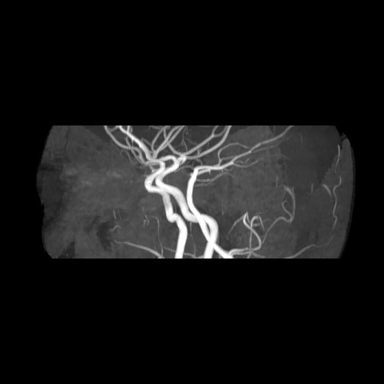 File:Artery of Percheron infarct (Radiopaedia 40966-43676 G 54).jpg