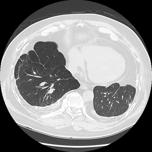 Asbestos-related pleural disease (Radiopaedia 74366-85250 Axial lung window 84).jpg