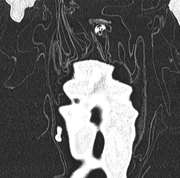 Aspergilloma- with Monod sign (Radiopaedia 44737-48532 Coronal lung window 106).jpg