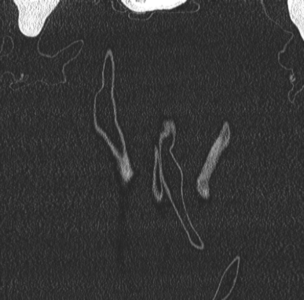 File:Aspergilloma- with Monod sign (Radiopaedia 44737-48532 Coronal lung window 62).jpg