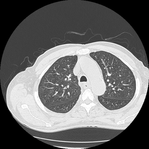 Aspergilloma (Radiopaedia 44592-48327 Axial lung window 22).jpg