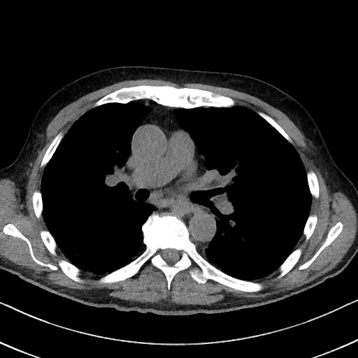 File:Aspergilloma on background pulmonary fibrosis (Radiopaedia 60942-68757 Axial non-contrast 28).jpg