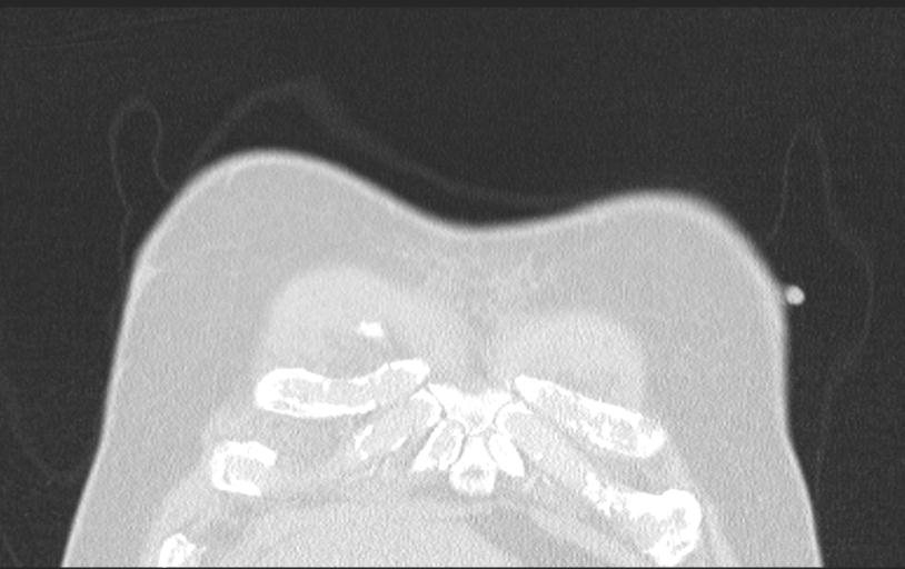 Aspirated tooth (Radiopaedia 28584-28844 Axial lung window 21).jpg