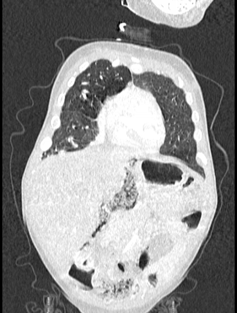 Asplenia syndrome (Radiopaedia 73083-83792 Coronal lung window 24).jpg