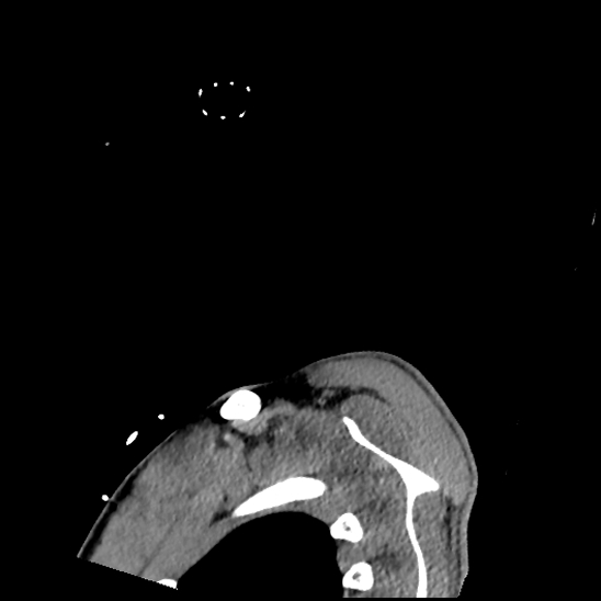 File:Atlanto-occipital dissociation (Traynelis type 1), C2 teardrop fracture, C6-7 facet joint dislocation (Radiopaedia 87655-104061 D 91).jpg