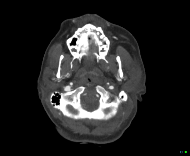 Atlanto-occipital dissociation - Traynelis type 1 (Radiopaedia 87570-103949 A 55).jpg