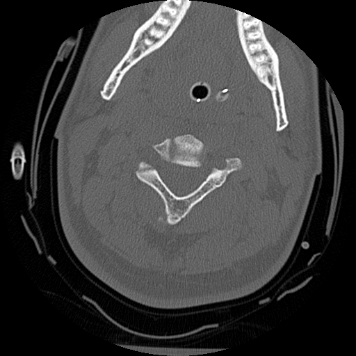 Atlanto-occipital dissociation injury (Radiopaedia 29274-29698 Axial bone window 26).png