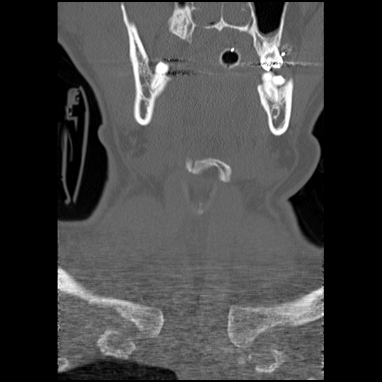 File:Atlanto-occipital dissociation injury (Radiopaedia 29274-29698 Coronal 53).png