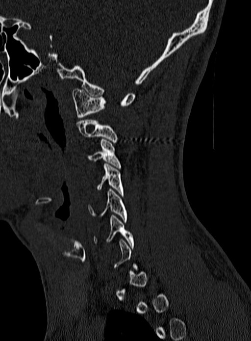 Atlantoaxial subluxation (Radiopaedia 44681-48450 Sagittal bone window 7).jpg