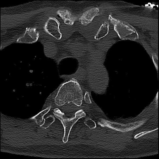 File:Atlas (type 3b subtype 1) and axis (Anderson and D'Alonzo type 3, Roy-Camille type 2) fractures (Radiopaedia 88043-104607 Axial bone window 89).jpg