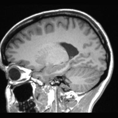 Atretic encephalocoele with inferior vermis hypoplasia (Radiopaedia 30443-31108 Sagittal T1 45).jpg