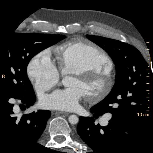 Atrial septal defect (upper sinus venosus type) with partial anomalous pulmonary venous return into superior vena cava (Radiopaedia 73228-83961 A 128).jpg