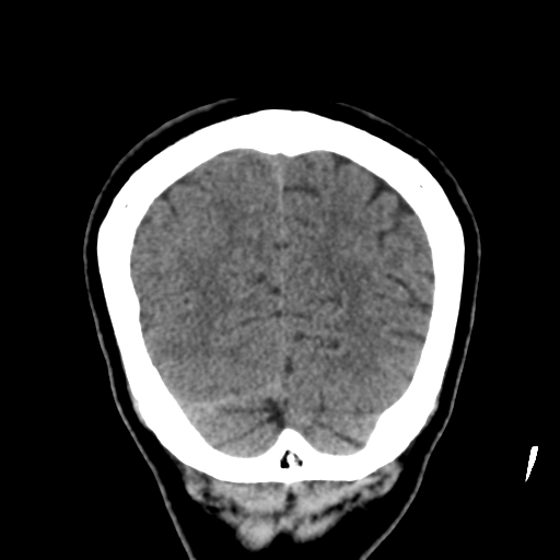 Atypical meningioma (WHO grade II) with osseous invasion (Radiopaedia 53654-59715 Coronal non-contrast 53).png