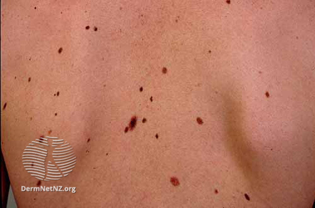 File:Atypical naevus (DermNet NZ lesions-atyp4).jpg