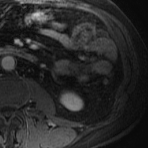 File:Atypical renal cyst on MRI (Radiopaedia 17349-17046 D 29).jpg