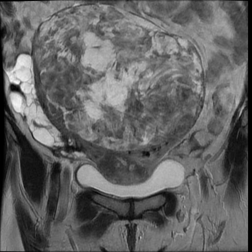 File:Atypical retroperitoneal lymphocoeles with large leiomyoma of uterus (Radiopaedia 32084-33027 Coronal T2 12).jpg