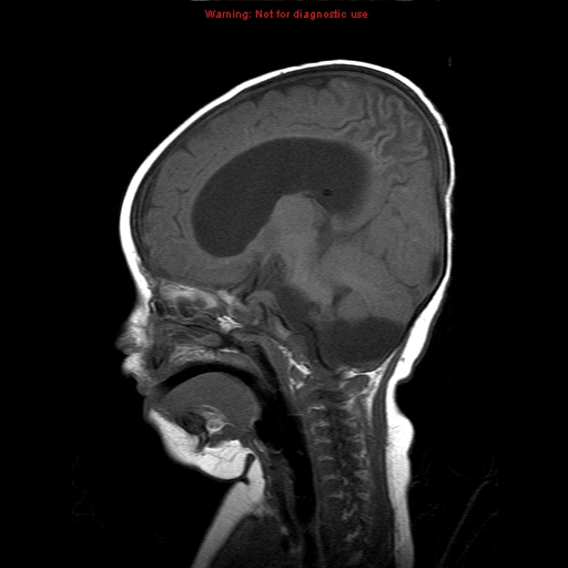 File:Atypical teratoid rhabdoid tumor (Radiopaedia 10712-11183 Sagittal T1 9).jpg
