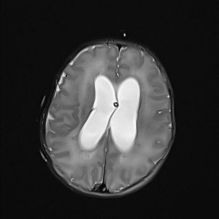 File:Atypical teratoid rhabdoid tumor (prenatal US and neonatal MRI) (Radiopaedia 59091-66388 Axial T2 21).jpg