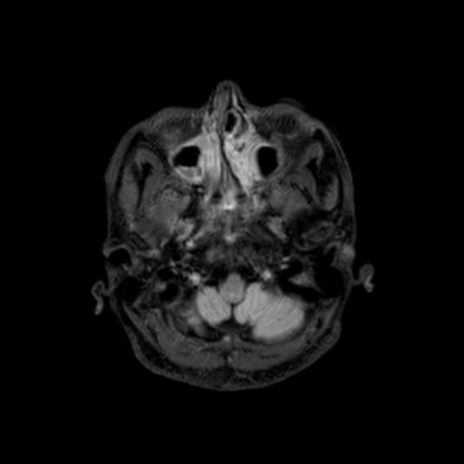 File:Autoimmune limbic encephalitis (Radiopaedia 30363-31005 Axial FLAIR 10).jpg