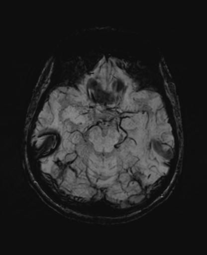 Autoimmune limbic encephalitis (Radiopaedia 30363-31005 SWI - mIP 26).jpg
