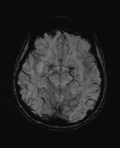 Autoimmune limbic encephalitis (Radiopaedia 30363-31005 SWI - mIP 30).jpg