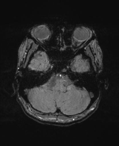 Autoimmune limbic encephalitis (Radiopaedia 30363-31005 SWI - magnitude 16).jpg