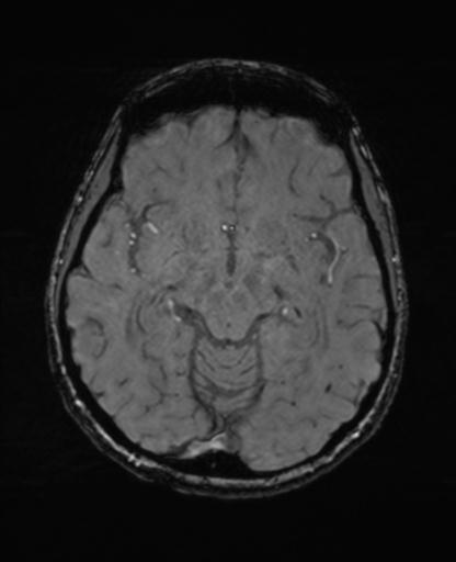 Autoimmune limbic encephalitis (Radiopaedia 30363-31005 SWI - magnitude 33).jpg