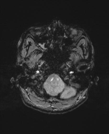 File:Autoimmune limbic encephalitis (Radiopaedia 30363-31005 SWI - magnitude 9).jpg