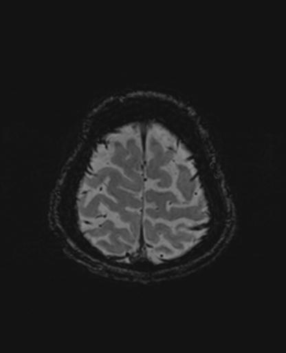 Autoimmune limbic encephalitis (Radiopaedia 30363-31005 SWI 72).jpg