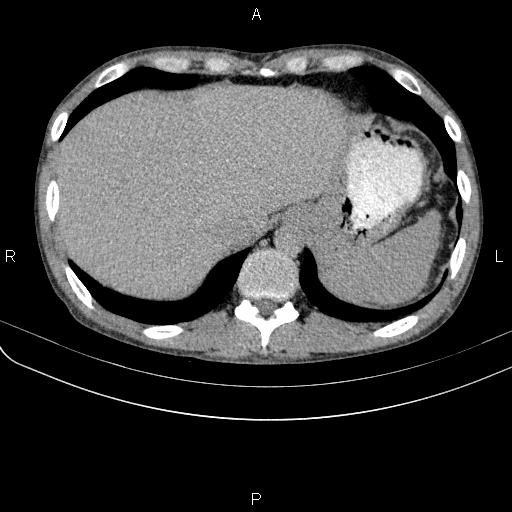 Autoimmune pancreatitis (Radiopaedia 84925-100431 Axial C+ delayed 3).jpg