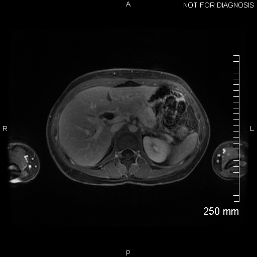 File:Autoimmune pancreatitis (Radiopaedia 88443-105101 A 53).jpg