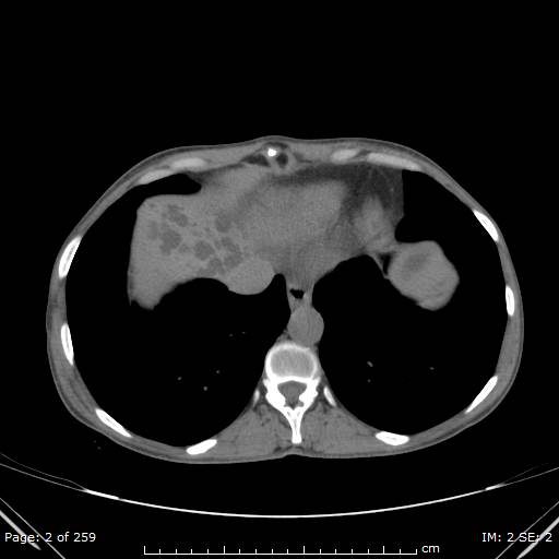 Autosomal dominant polycystic kidney disease (Radiopaedia 44122-47684 Axial non-contrast 1).jpg