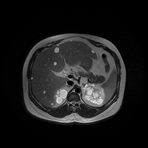 File:Autosomal dominant polycystic kidney disease (Radiopaedia 50259-55611 Axial T2 15).jpg