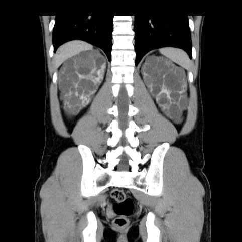 File:Autosomal dominant polycystic kidney disease (Radiopaedia 66349-75582 A 69).jpg