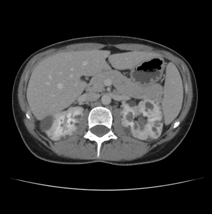Autosomal dominant polycystic kidney disease - early onset (Radiopaedia 40734-43387 A 22).jpg