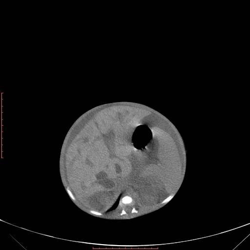 Autosomal recessive polycystic kidney disease associated with Caroli disease (Radiopaedia 61932-69984 Axial non-contrast 149).jpg