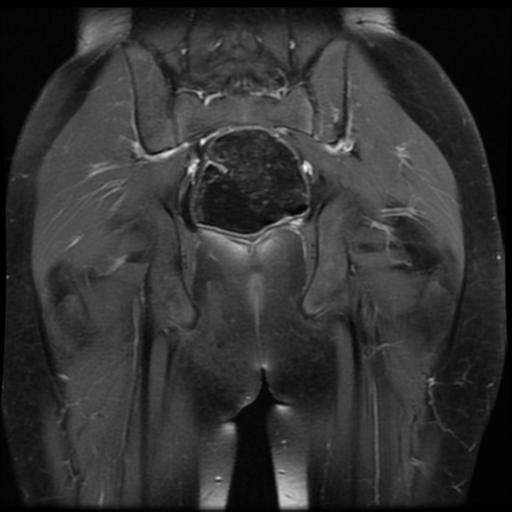 File:Avascular necrosis of the hip (Radiopaedia 29563-30067 I 14).jpg