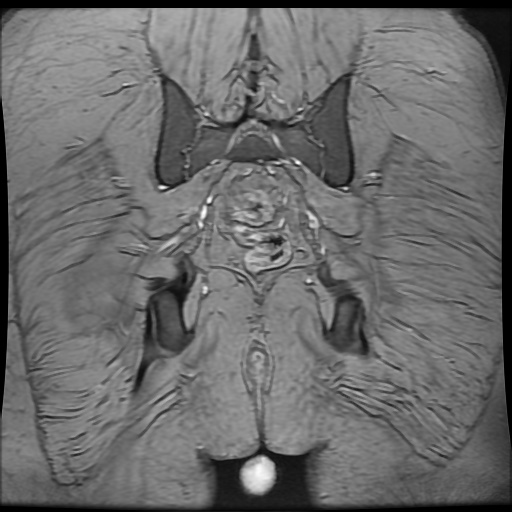 Avascular necrosis of the hip (Radiopaedia 61503-69465 F 91).jpg