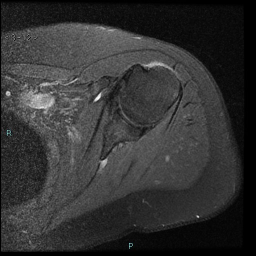 File:Avascular necrosis of the shoulder - Cruess stage I (Radiopaedia 77674-89886 Axial PD fat sat 12).jpg