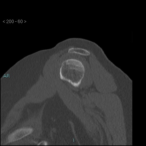 Avascular necrosis of the shoulder - Cruess stage I (Radiopaedia 77674-89887 Sagittal bone window 59).jpg